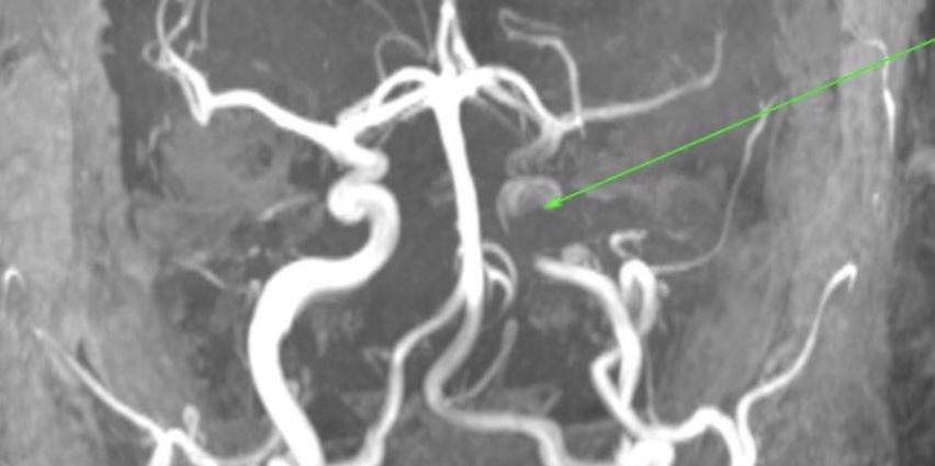 Reduced flow in the left internal carotid artery (arrow) due to presence of thrombus.