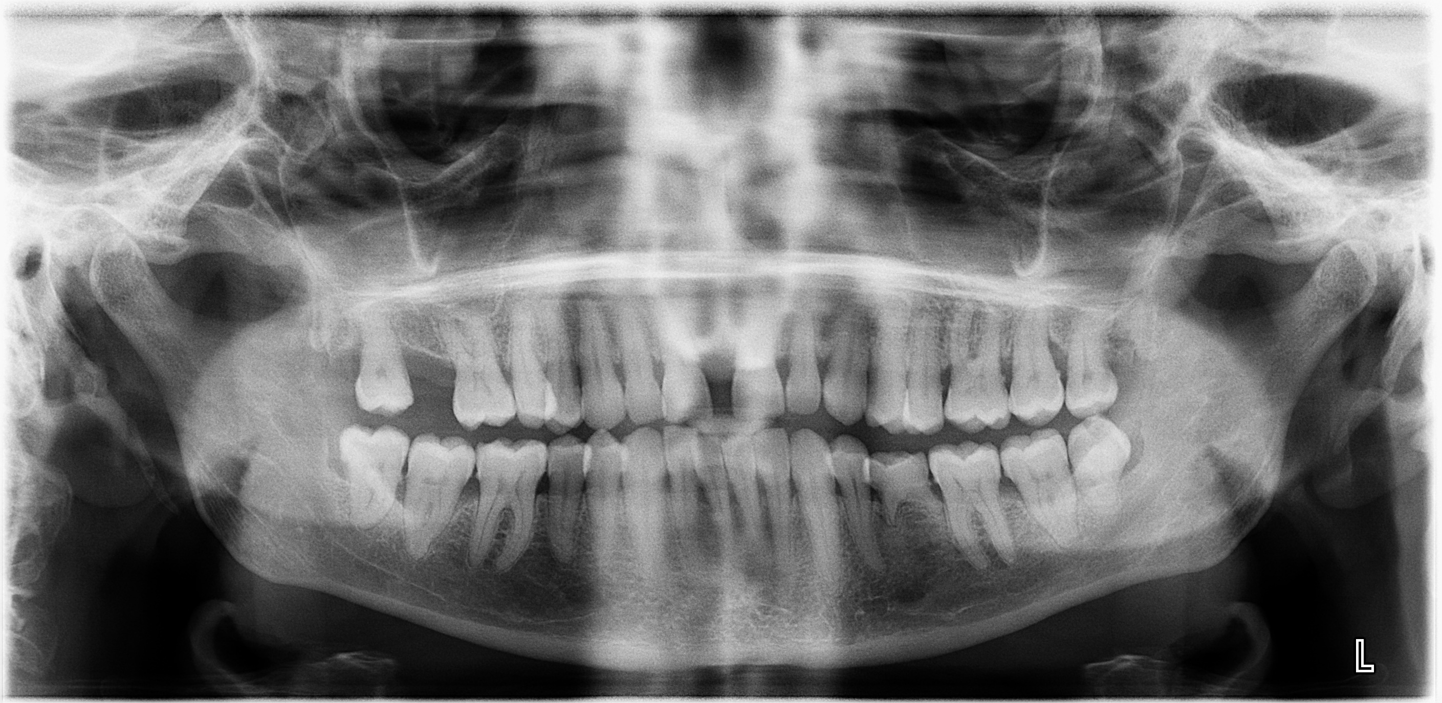 orthopantomogram of necrotising sialometaplasia