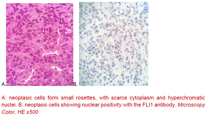 A: neoplasic cells form small rosettes, with scarce cytoplasm and hyperchromatic nuclei. B. neoplasic cells showing nuclear positivity with the FLI1 antibody. Microscopy Color, HE x500