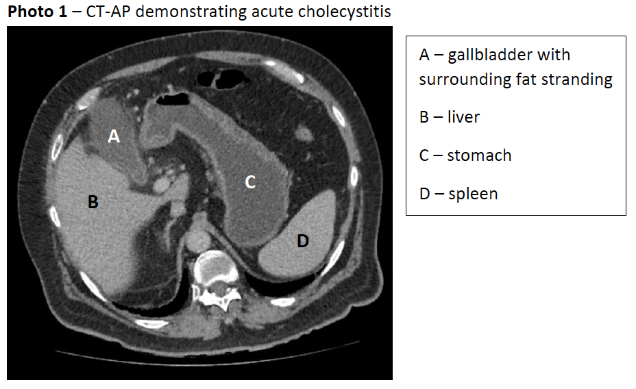 CT-AP demonstrating acute cholecystitis