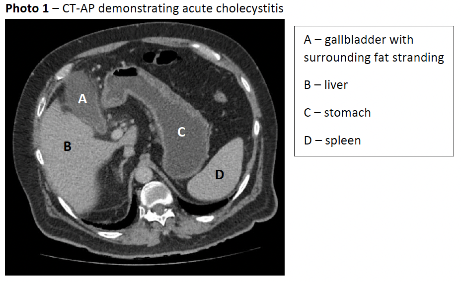 cholecystitis x ray