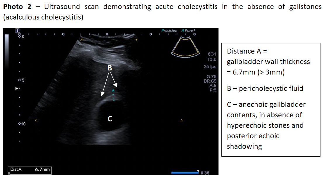 Ultrasound scan demonstrating acute cholecystitis in the absence of gallstones (acalculous cholecystitis)