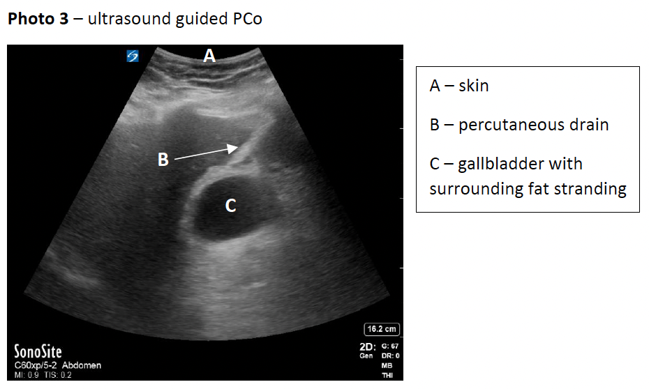 Ultrasound guided PCo