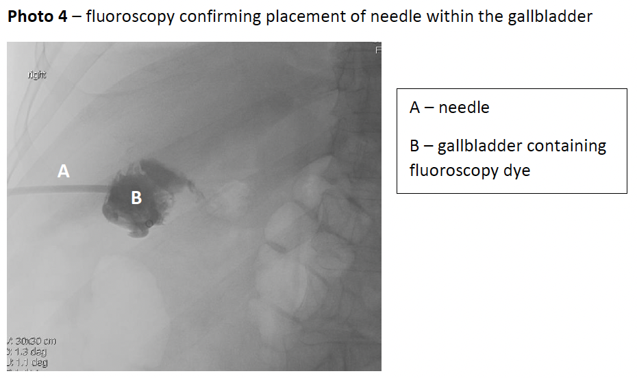 Fluoroscopy confirming placement of needle within the gallbladder
