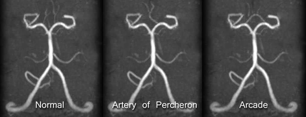 Caption: Variations of medial thalamomesencephalic blood supply, showing the normal variant (left), Artery of Percheron (middle), and the arcade (right). Case courtesy of Assoc Prof Frank Gaillard, <a href="https://radiopaedia.org/">Radiopaedia.org</a>. From the case <a href="https://radiopaedia.org/cases/35924">rID: 35924</a>