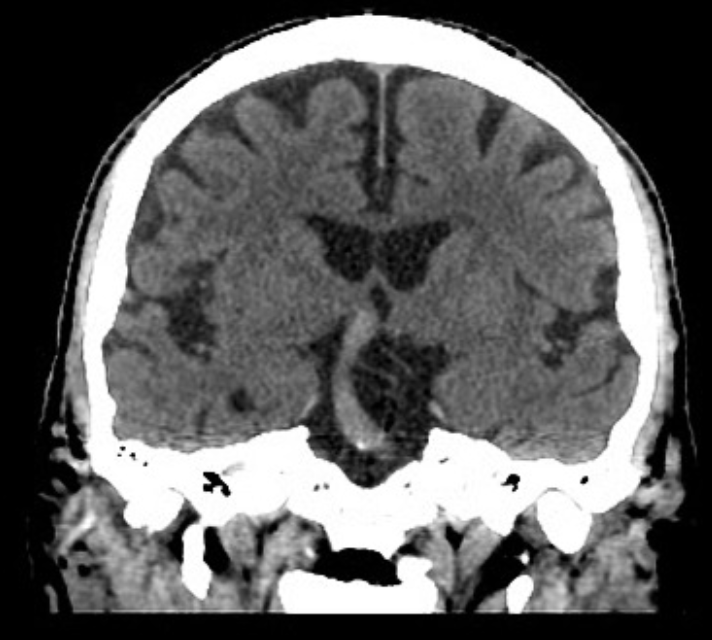 Caption: Coronal view of a non-contrast computed tomography (NCCT) scan of the brain showing an elongated and ectatic basilar artery which measures up to 9 mm in diameter at its proximal segment. Case courtesy of Dr. Eduardo Torres, <a href="https://radiopaedia.org/">Radiopaedia.org</a>. From the case <a href="https://radiopaedia.org/cases/65518">rID: 65518</a>