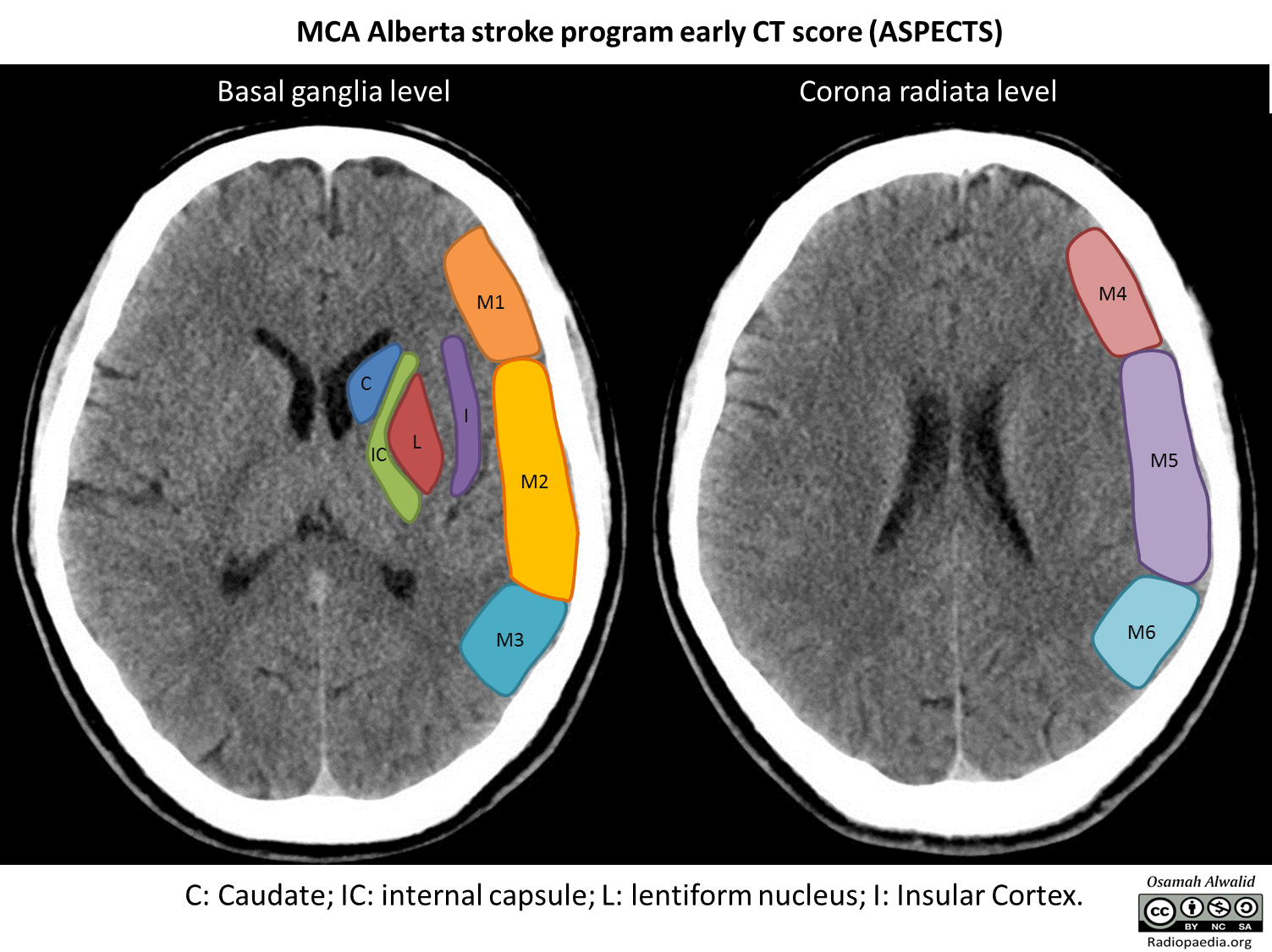 Caption: Illustration of the Alberta stroke program early CT score (ASPECTS) of the middle cerebral artery. Case courtesy of Dr Osamah A. A. Alwalid, <a href="https://radiopaedia.org/">Radiopaedia.org</a>. From the case <a href="https://radiopaedia.org/cases/72706">rID: 72706</a>