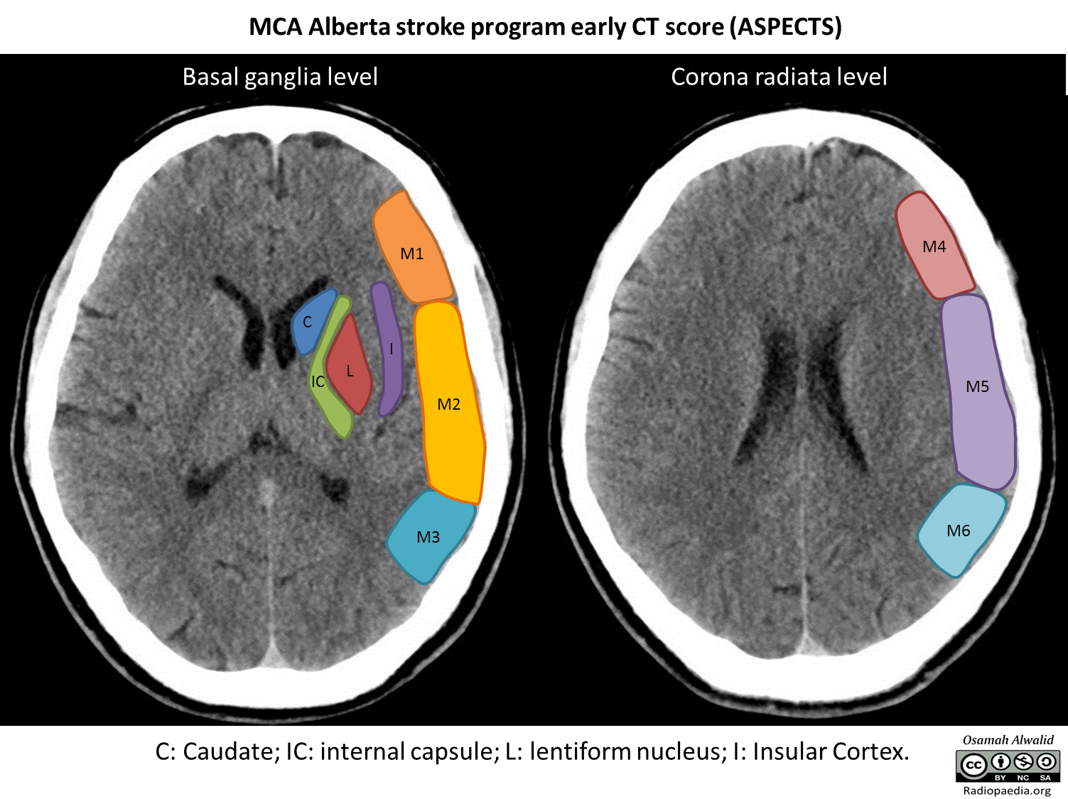 cerebral artery stroke case study