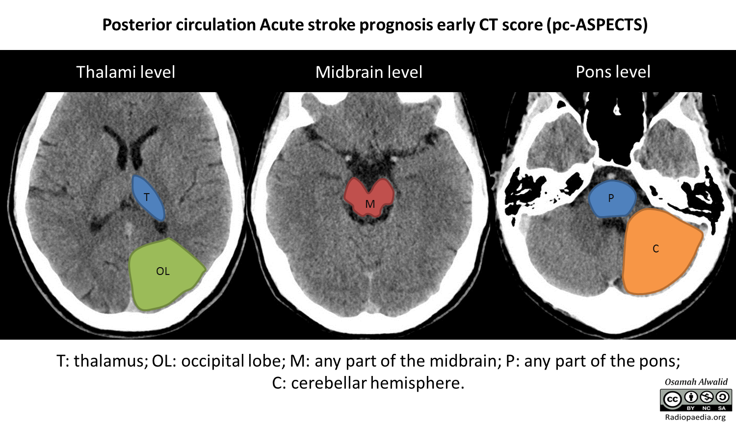 Figure 5: Illustration of the acute stroke prognosis early CT score (ASPECTS) of the posterior circulation. Case courtesy of Dr Osamah A. A. Alwalid, <a href="https://radiopaedia.org/">Radiopaedia.org</a>. From the case <a href="https://radiopaedia.org/cases/72707">rID: 72707</a>