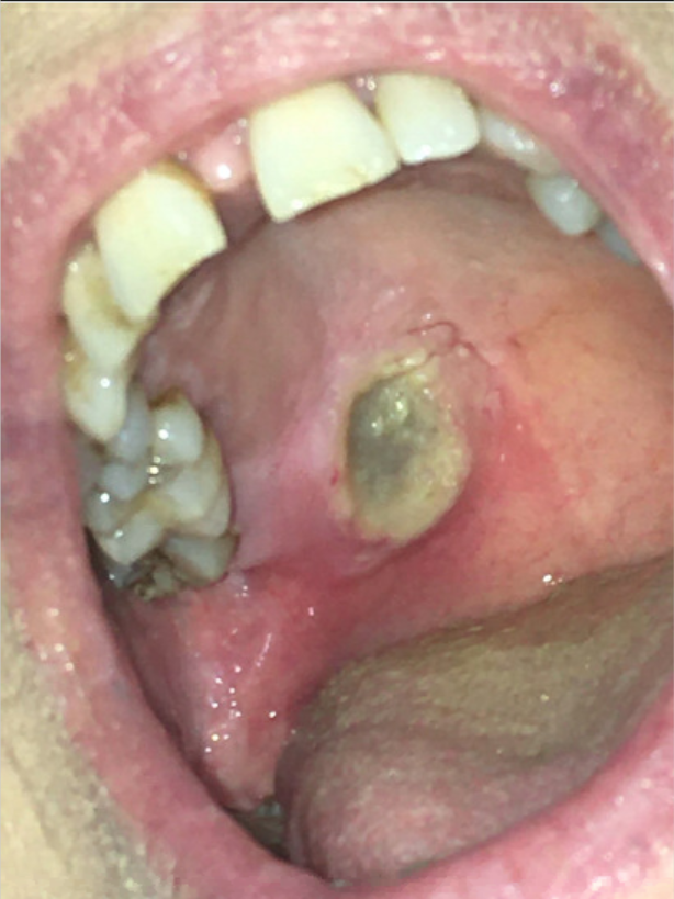 Clinical photograph 7 days after presentation