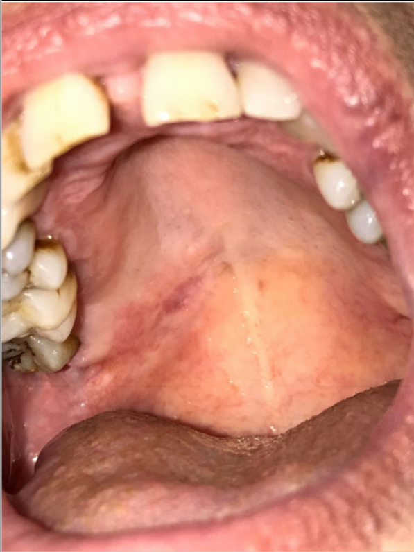 Clinical photograph 3 months after presentation