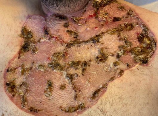 Figure 4: 28 days after debridement there is adequate healing of skin graft with some dry areas.
