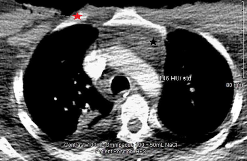 Figure 2: Day 2 ICU CT neck and thorax with contrast.  There is persisting subcutaneous induration and oedema in the visceral compartment of the neck on the left side (red star), with swelling and induration of the anterior mediastinal fat (black star).  