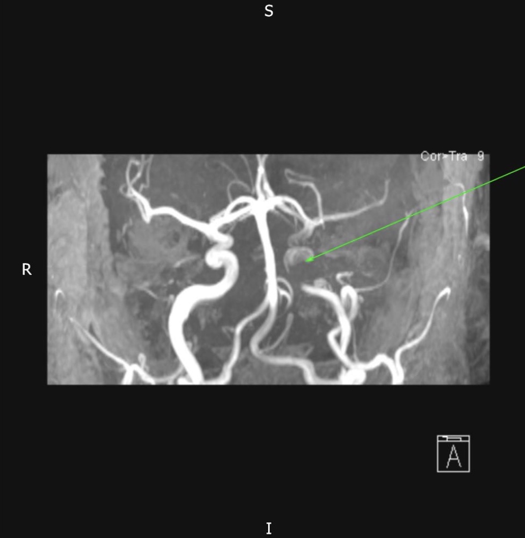 Reduced flow in the left internal carotid artery (arrow) due to presence of thrombus.