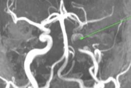 Reduced flow in the left internal carotid artery (arrow) due to presence of thrombus.