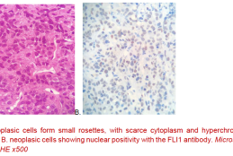 A: neoplasic cells form small rosettes, with scarce cytoplasm and hyperchromatic nuclei. B. neoplasic cells showing nuclear positivity with the FLI1 antibody. Microscopy Color, HE x500